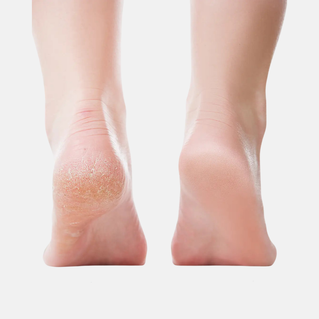 NovaPro™ - Callus Remover